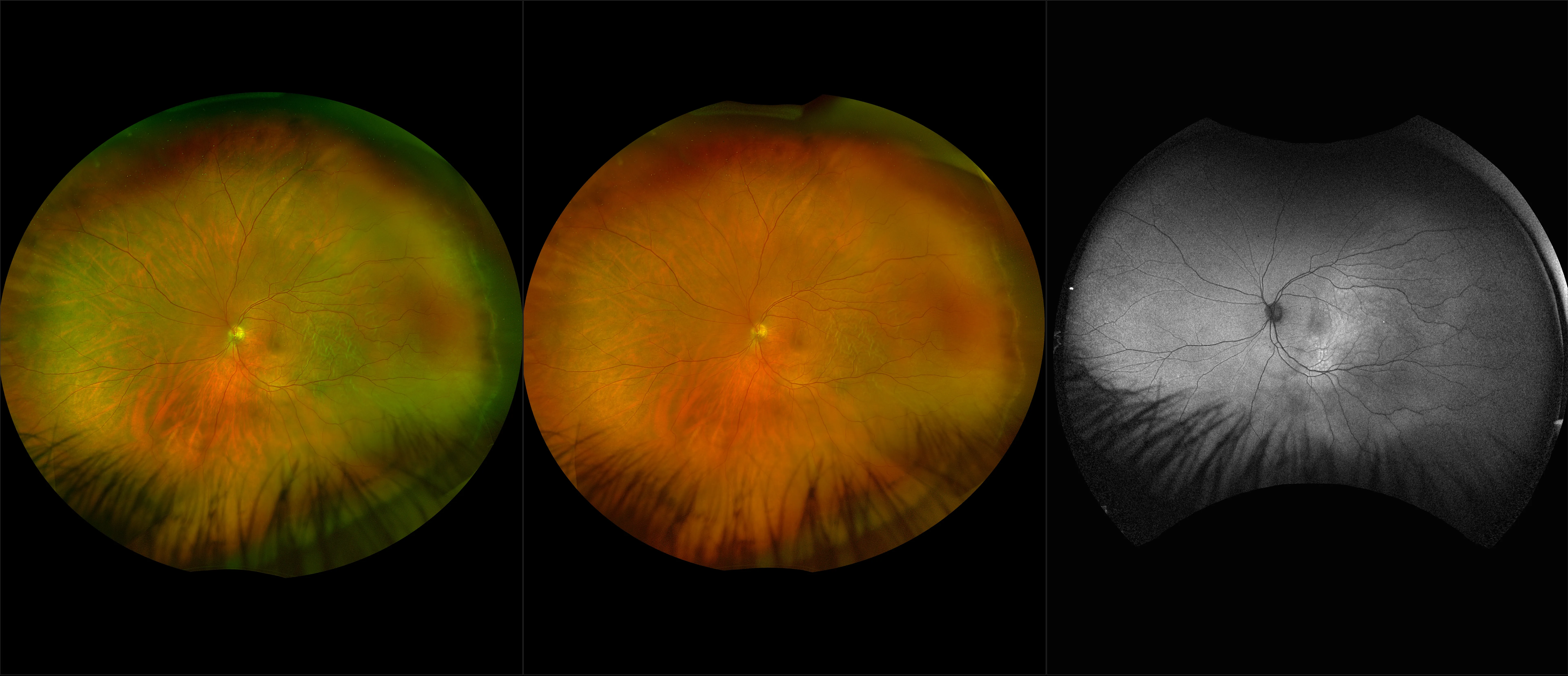 California - Retinal Detachment, RG, RGB, AF